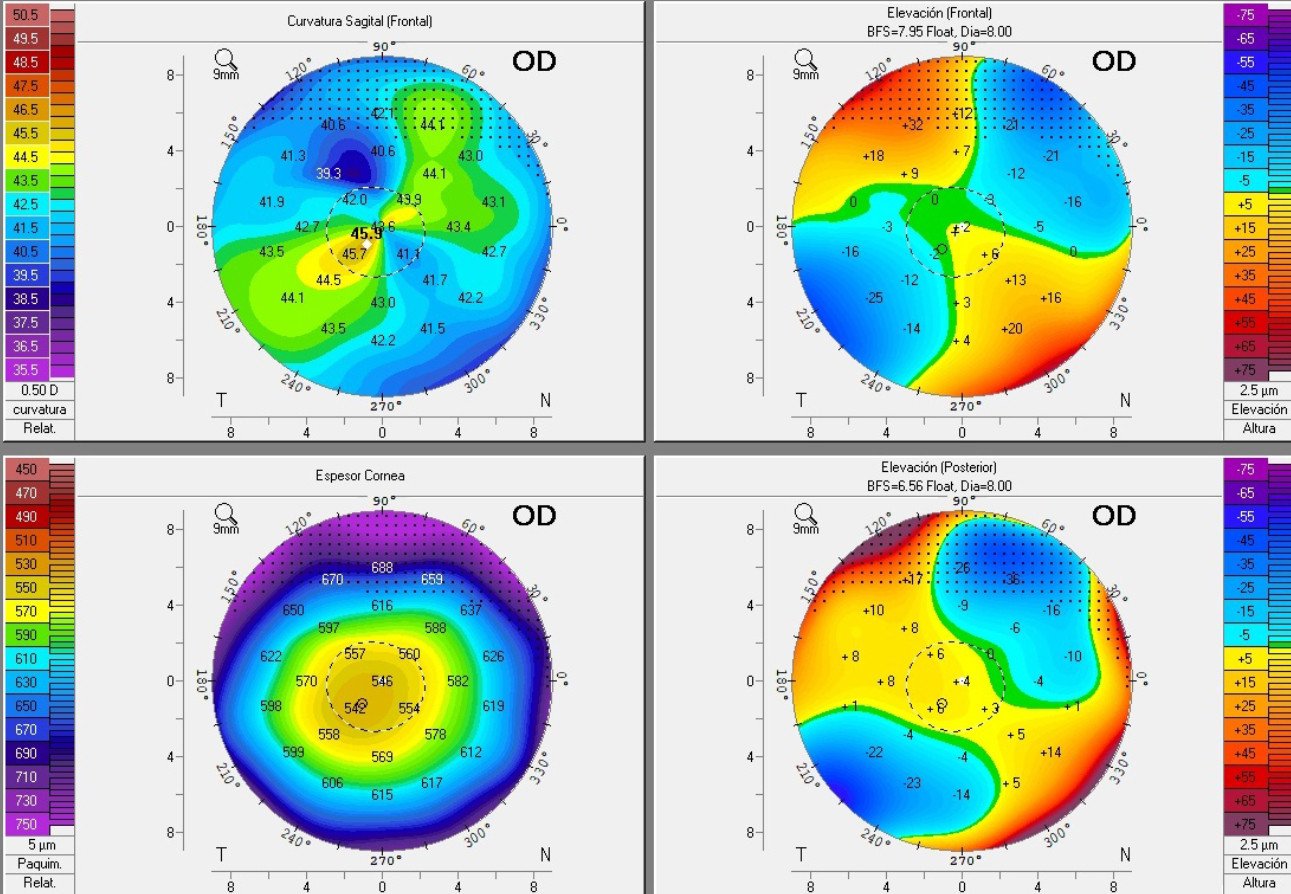 Topografía Corneal