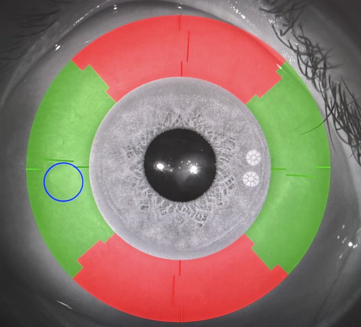 Perfilometría Ocular